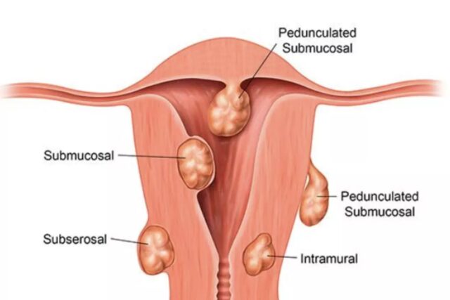 자궁근종 수술 6가지, 자궁 근종이 생기는 원인 증상 통증 진단을 위한 검사, 임신 폐경기 등과의 연관성에 대해
