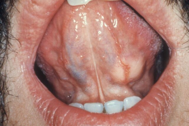 침샘암 증상 원인, 침샘 종양으로 인한 부음 비대증 일어난다면? 진단 치료 관리 합병증 정보까지