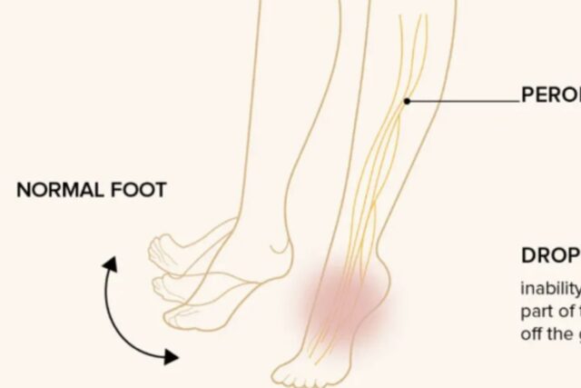 발가락 발바닥 마비 일으키는 풋드랍 (Foot Drop) 원인 및 증상, 치료 및 관리 방법