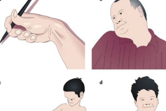 근긴장 이상증 근육 수축 뒤틀림 장애 원인 및 증상, 치료 정보 목이 제멋대로 한쪽으로 돌아갈 때 목이 안돌아갈때