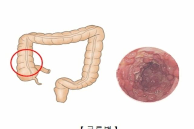 [헬스S] ‘닥터 차정숙’서 논란, 크론병은 뭔가요