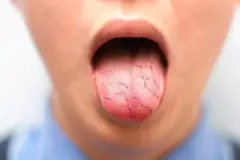 쇼그렌증후군증상 중 하나인 구강건조 입마름 관리하기 위한 자일리멜츠에 대해