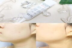 화농성여드름 원인, 마스크 피부 트러블 볼 여드름 흔적 연고 낫츠 후기