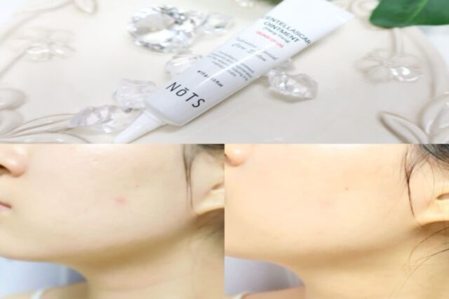 화농성여드름 원인, 마스크 피부 트러블 볼 여드름 흔적 연고 낫츠 후기