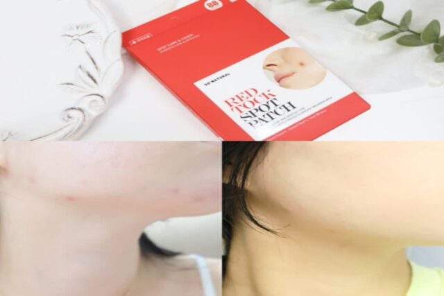 쏘내추럴 레드 톡 스팟 패치 후기, 여드름 트러블 뾰루지패치 추천