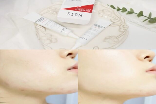 얼굴 피부 좁쌀여드름 케어 낫츠 센텔라스카 연고 화장품 추 (볼,턱)