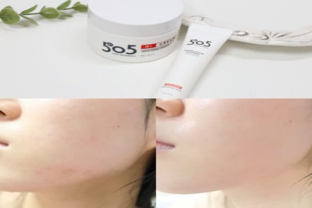 접촉성피부염, 얼굴 피부 여드름크림,여드름연고 후기