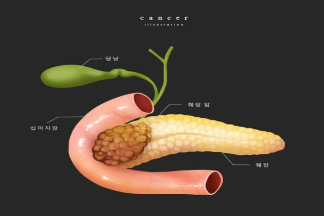 [헬스S] “나이 들었다고 췌장암 수술 겁내지 마세요”
