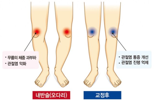 차렷해도 닿지 않는 오다리, 젓가락 다리로 바꿔주는 비법은