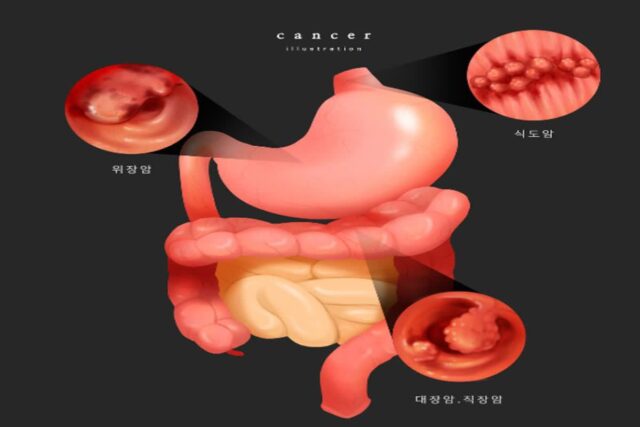 [헬스S] “직장암 수술로 항문 잃을 걱정은 마세요”