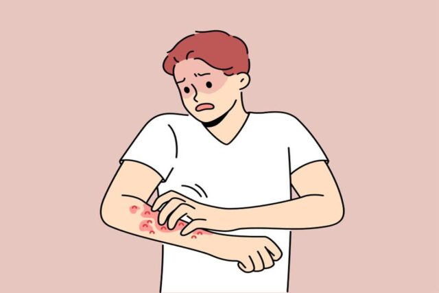 [헬스S] 가을만 되면 ‘인설’ 우수수… 건선 관리법은