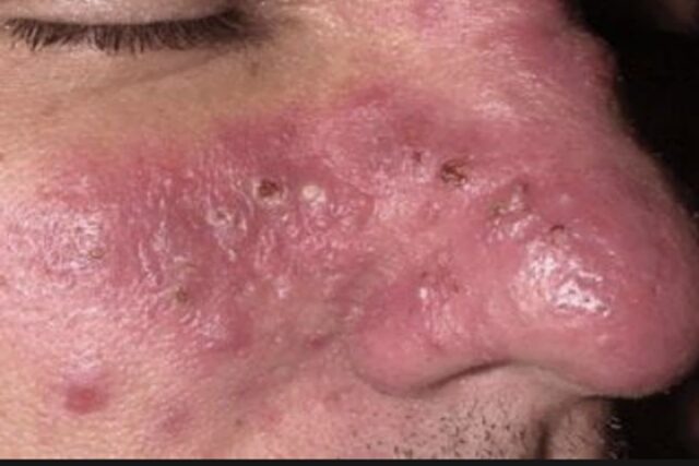 코 빨개짐 딸기코 주사비 빨간 코 홍조 원인 및 증상 코가 빨개지는 이유 따른 치료 및 관리