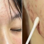 여름철 폭발하는 피지에 심해지는 ‘여드름’ 깔끔하게 없애주는 증상별 ‘약국 연고’