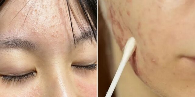 여름철 폭발하는 피지에 심해지는 ‘여드름’ 깔끔하게 없애주는 증상별 ‘약국 연고’