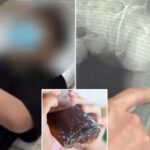 물 대신 콜라 마시던 35세 남성, 기침만 했는데 ‘허벅지 뼈’ 두 동강 나…“뼈 나이 80세”
