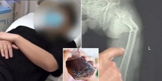물 대신 콜라 마시던 35세 남성, 기침만 했는데 ‘허벅지 뼈’ 두 동강 나…“뼈 나이 80세”