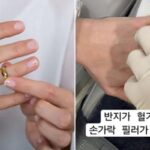 살 빠져 반지 헐거워지자 손가락에 ‘필러’ 맞은 여성