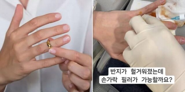 살 빠져 반지 헐거워지자 손가락에 ‘필러’ 맞은 여성