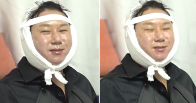 빚 청산 하더니…얼굴에 붕대 감고 퉁퉁 부은 채로 해맑게 웃으며 방송 출연한 이상민
