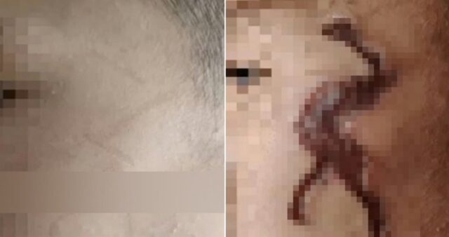 흉터 없애려고 중국 쇼핑몰서 산 ‘흉터 제거 젤’ 발랐는데… 오히려 얼굴에 ‘궤양’ 생긴 소년