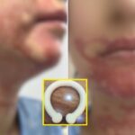 목에 두르자마자 폭발한 ‘넥 워머’… 결혼 앞둔 예비신부 얼굴에 지울 수 없는 화상 남겼다