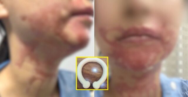 목에 두르자마자 폭발한 ‘넥 워머’… 결혼 앞둔 예비신부 얼굴에 지울 수 없는 화상 남겼다