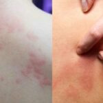 실내서 에어컨 빵빵 쐬다 밖에 나오면 너무 가려워요… 여름철 공포라는 ‘이 증상’
