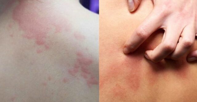 실내서 에어컨 빵빵 쐬다 밖에 나오면 너무 가려워요… 여름철 공포라는 ‘이 증상’