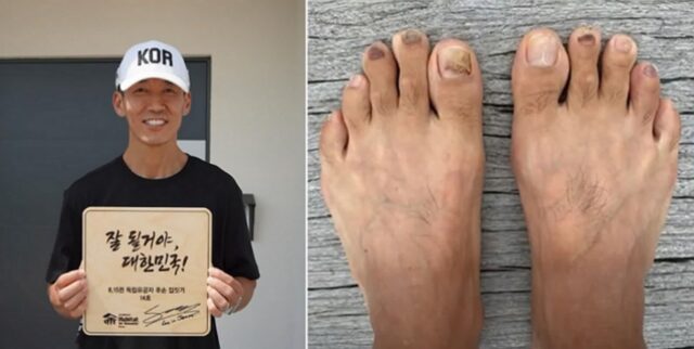 마라톤 뛰며 발톱 6개 빠진 션… 주변에서 말리는데도 5년째 81.5km 뛰는 이유