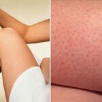 “면도기로 제모하지 마세요”… 피부에 ‘붉은 반점’ 생겼던 충격적인 이유