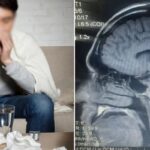 교통사고 당한 뒤 6년간 ‘콧물’ 줄줄 흘리던 남성… 알고 보니 ‘뇌척수액’