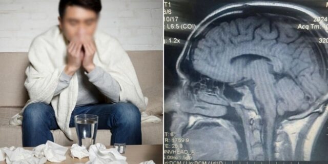 교통사고 당한 뒤 6년간 ‘콧물’ 줄줄 흘리던 남성… 알고 보니 ‘뇌척수액’