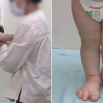 핏줄에 혹 생기는 희소병 앓는 2살 호빈이, 신약 치료 후 15명 살렸다 (영상)