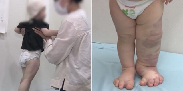 핏줄에 혹 생기는 희소병 앓는 2살 호빈이, 신약 치료 후 15명 살렸다 (영상)