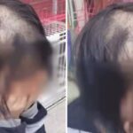 “집 앞 미용실서 염색했다가 머리카락 다 끊겨 ‘대머리’ 됐습니다” (사진)