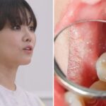 설암 3기 투병에 혀 1/3 절제한 유명 여가수… “충치로 시작됐다”