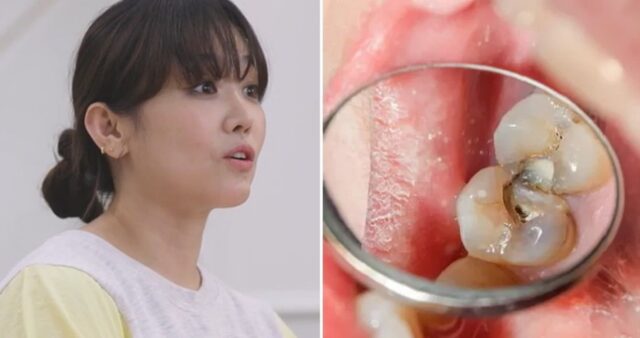 설암 3기 투병에 혀 1/3 절제한 유명 여가수… “충치로 시작됐다”