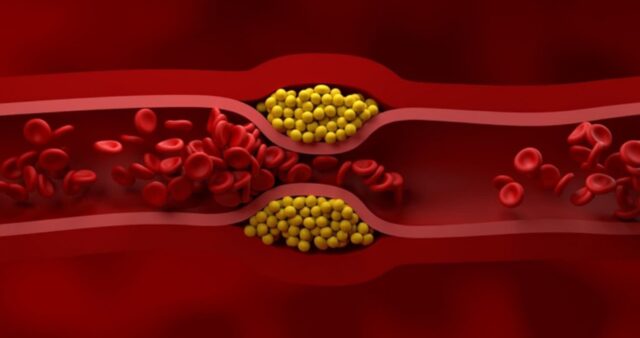 건강검진 결과 충격 받았다면 주목… 혈관 속 시한폭탄 콜레스테롤 박멸하는 ‘이것’