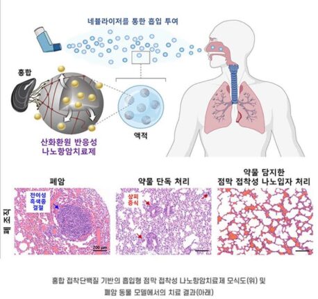 폐 점막에 직접 작용하는 ‘흡입형 폐암 치료제’ 개발