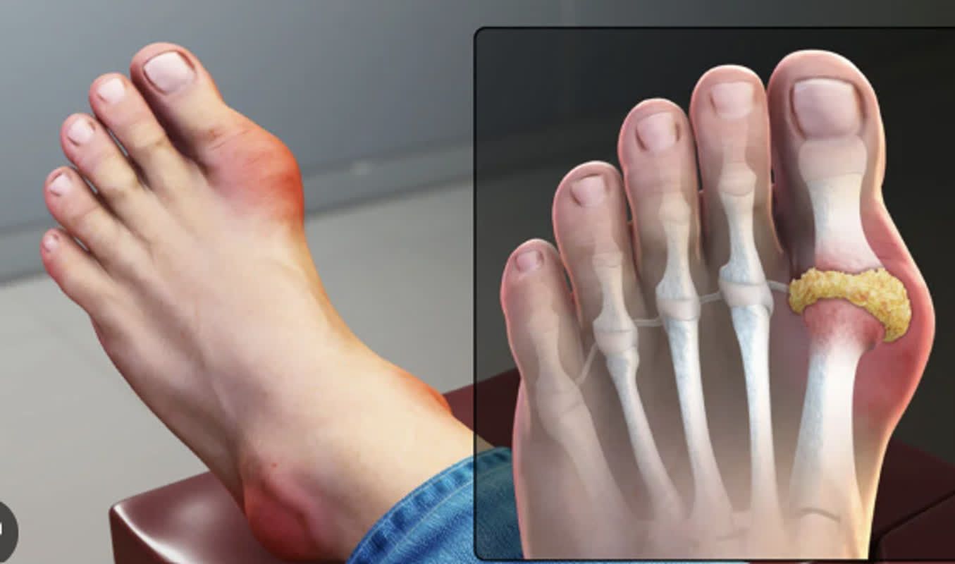 엄지발톱 염증 원인 및 증상 조갑주위염 손발톱 주위 감염, 내성발톱 으로 인해서, 치료 및 관리 방법 | 건강한 삶을 리뷰하는 Heeee, image size:1355x800