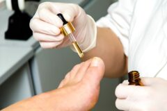 무좀 치료 자연요법, 식초와 마늘도 효능… 사용 전 테스트 중요