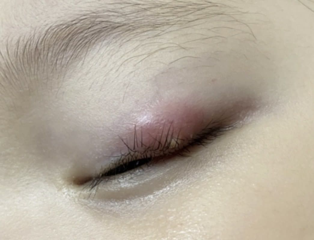 다리에 보라색 핏줄이 많이 보이고 멍이 들어있어요 ㅣ 궁금할 땐, 아하!, image size:1045x800