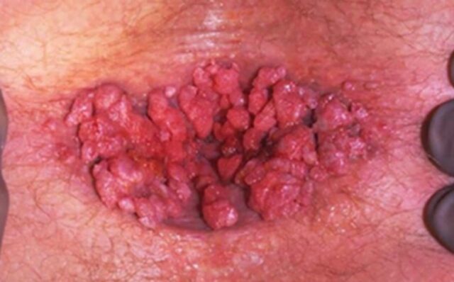 항문 사마귀 단순한 종기 혹 이라고 치부하면 큰일나요