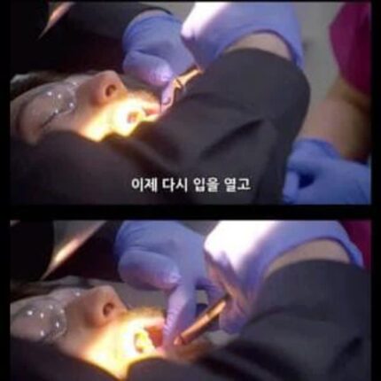 자 마취 안하고 사랑니 뽑을게요 레드썬