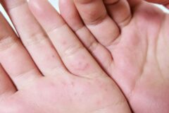 피부에 물집 자주 생기면 “희귀 피부질환인 이것” 의심하세요