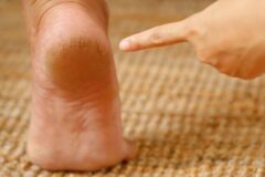 발뒤꿈치에 “이 변화”가 보인다면, 심장이 위험합니다! 이렇게 해 보세요!