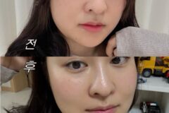온다리프팅 효과 후기! 이중턱살 빼는법과 얼굴 윤곽관리로 잘 고른듯