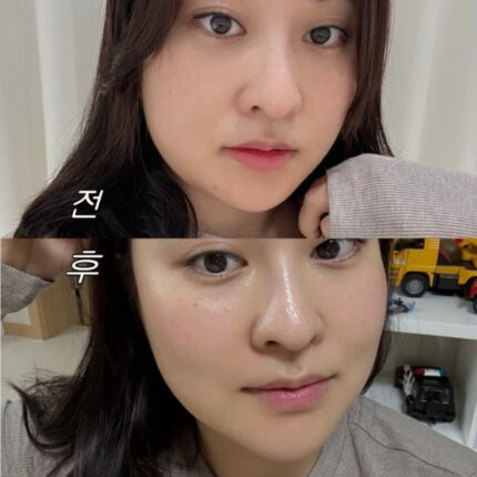 온다리프팅 효과 후기! 이중턱살 빼는법과 얼굴 윤곽관리로 잘 고른듯