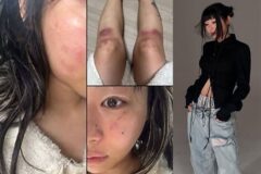 유명 女가수, ‘전 연인’에 데이트폭력 당해… (+사진)