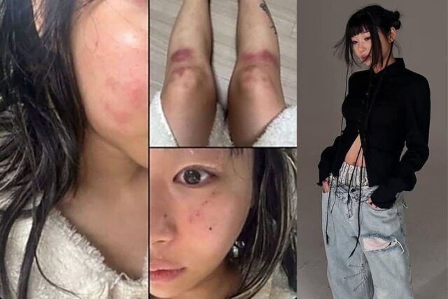유명 女가수, ‘전 연인’에 데이트폭력 당해… (+사진)